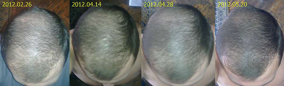 Фотографии результатов применения методики Джека для остановки выпадения волос