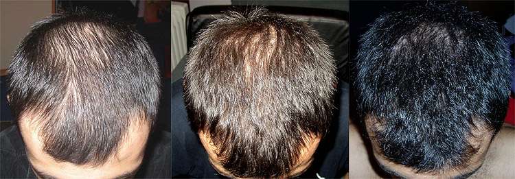 Как выглядят волосы спустя четыре месяца лечения миноксидилом и упражнениями для скальпа