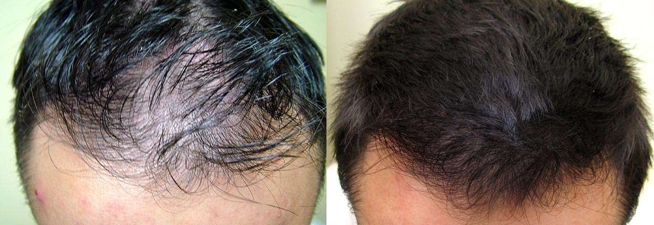 Увеличение густоты волос с помощью финастерида