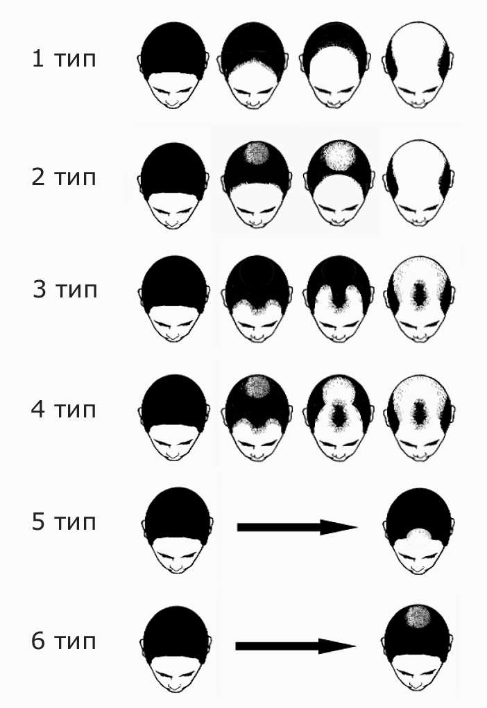 Стадии выпадения волос у женщин и мужчин азиатов