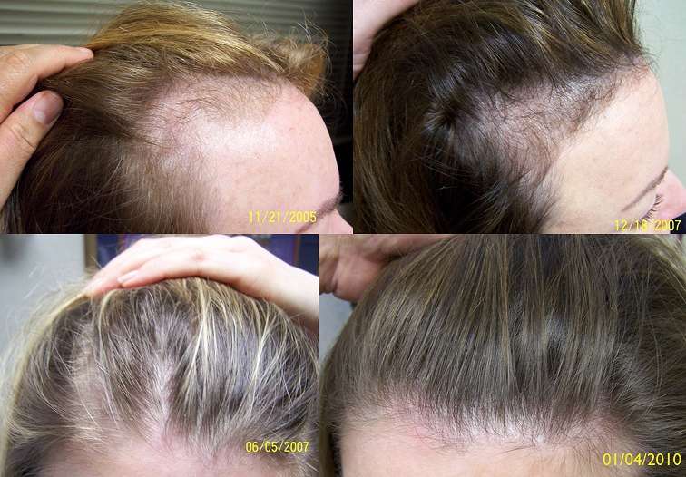 Миноксидил когда прекращается выпадение волос