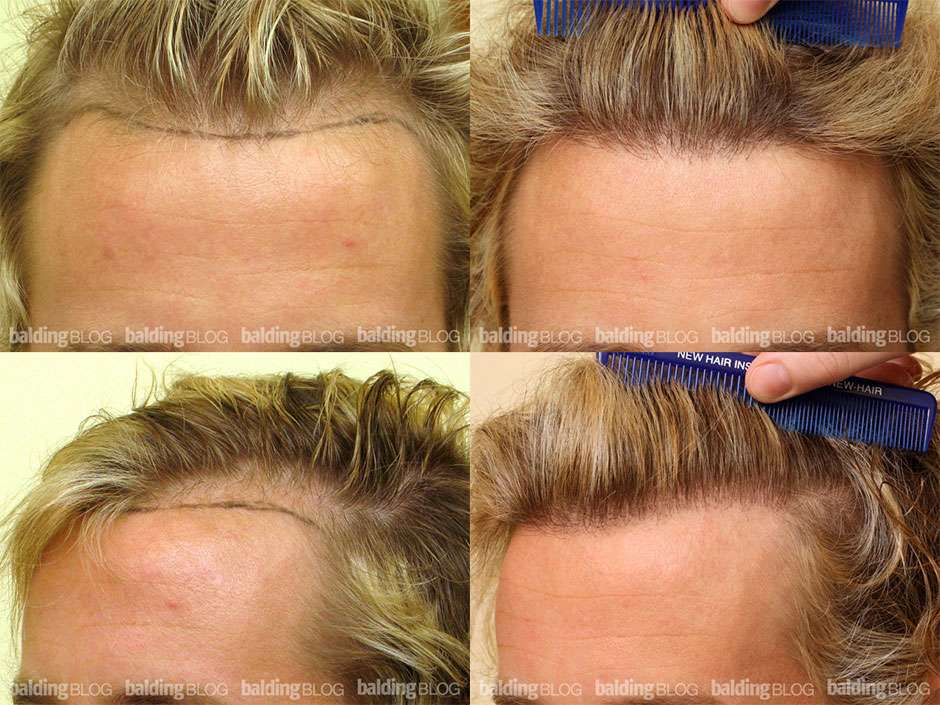 Восстановление густоты по линии роста волос