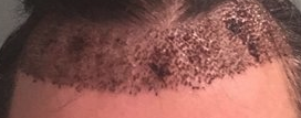 Корки после пересадки волос