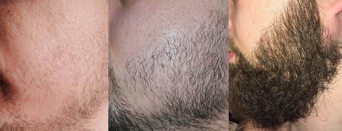 Фото до и после применения миноксидила для роста бороды